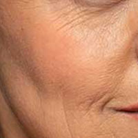 Wrinkles & Aging