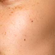 Blackheads
