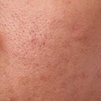 Open Pores