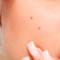 Dark Spots & Moles
